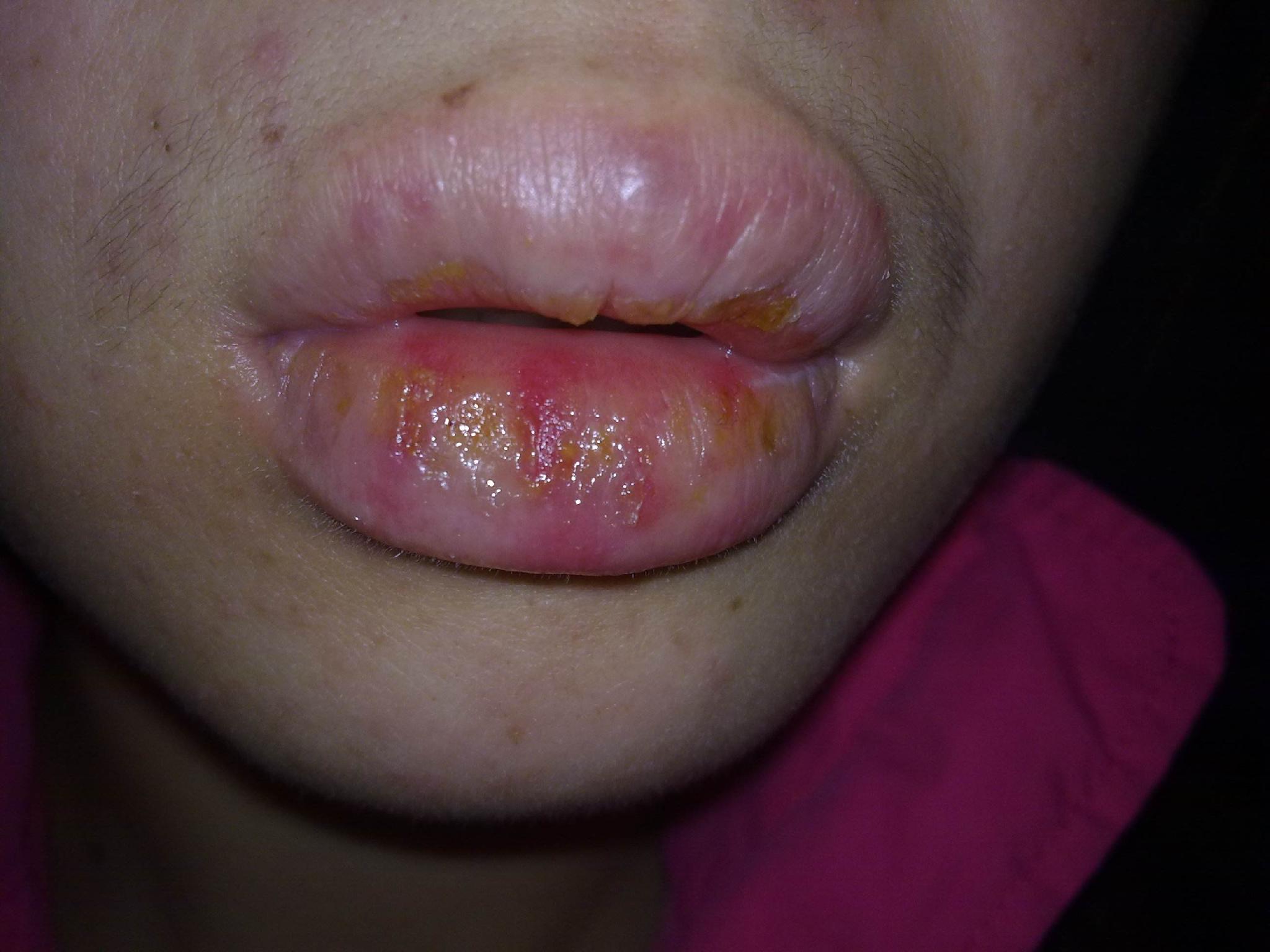 嘴唇肿瘤图片图片