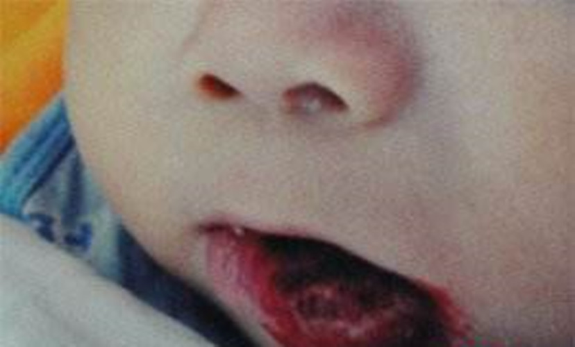 唇癌的早期菜花状图片