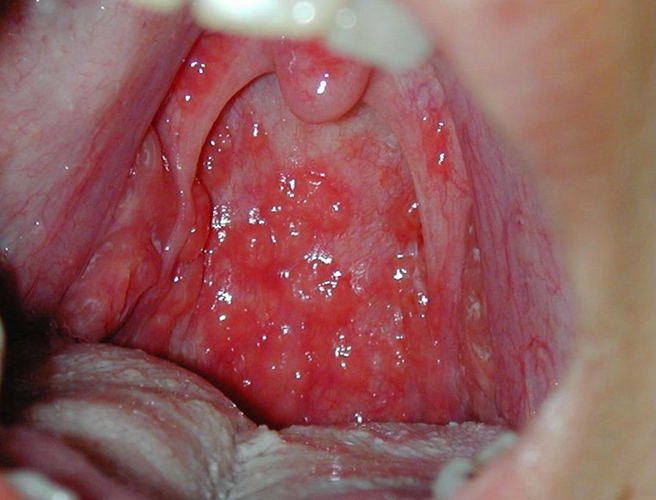 孕期的急性咽炎图片