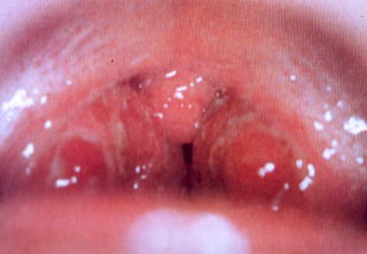 急性咽炎的症状图片