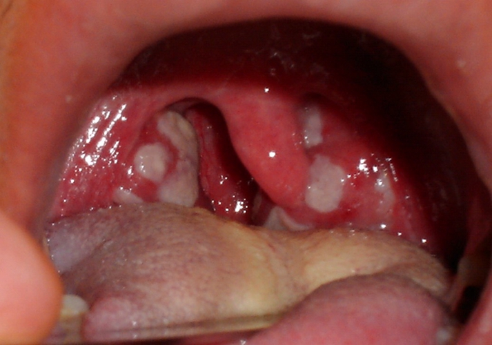 柯萨奇病毒急性喉炎末期的症状图片