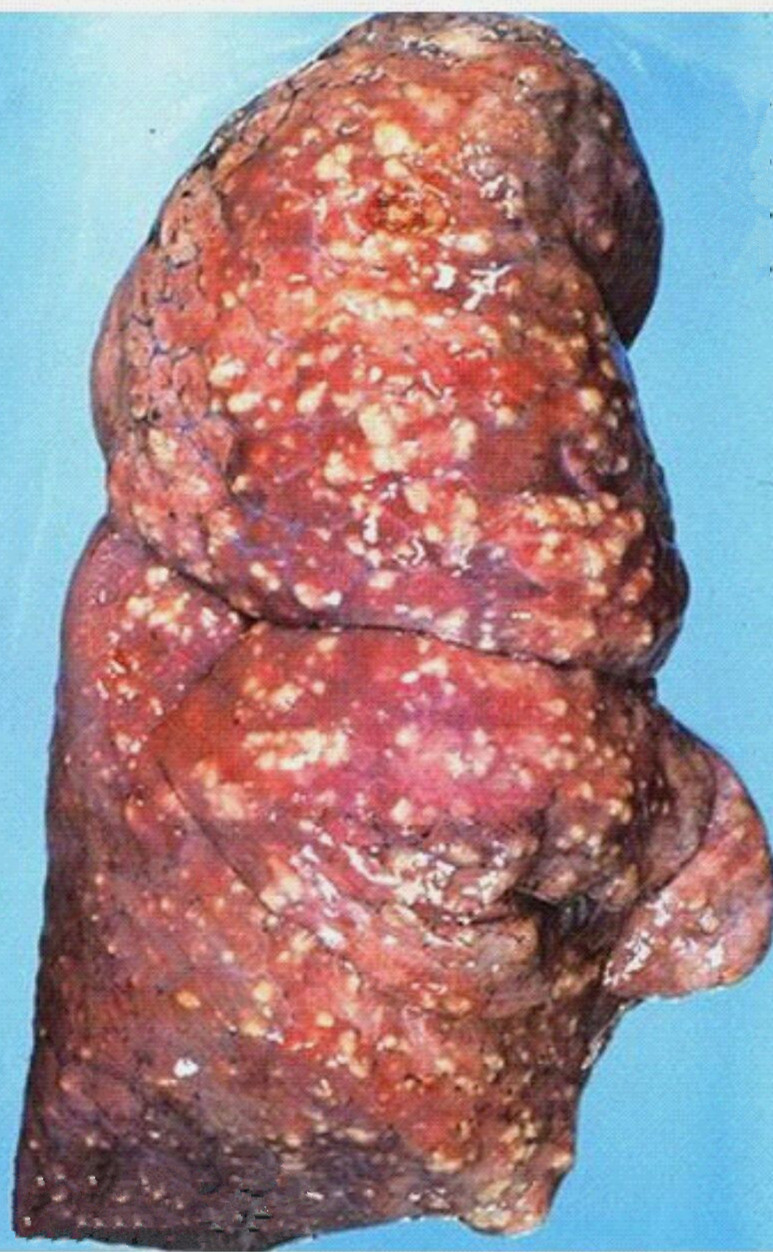肺结核