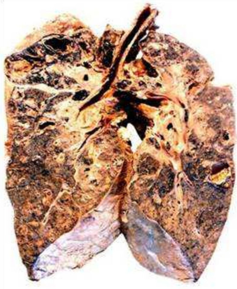 原发性肺结核图片