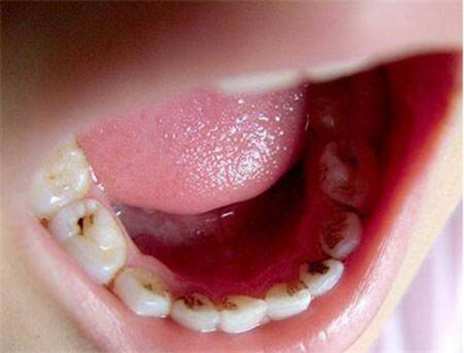儿童牙根尖炎症状图片图片