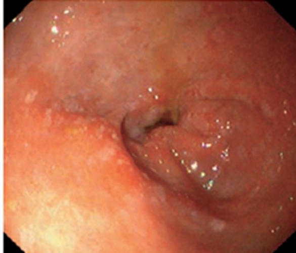 急性糜烂性的胃炎充血症状图片