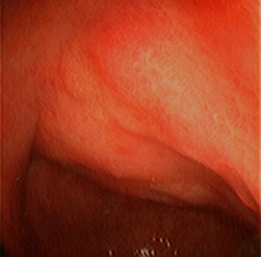 急性胃炎的症状表现的图片