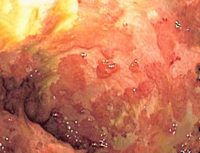 慢性结肠炎患者土方法治疗的图片