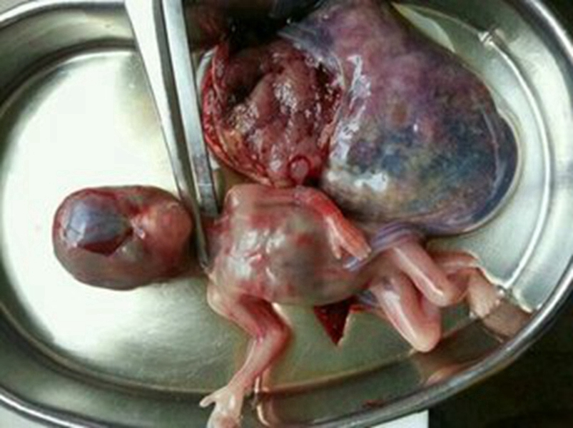 20天流产的胚胎图片图片