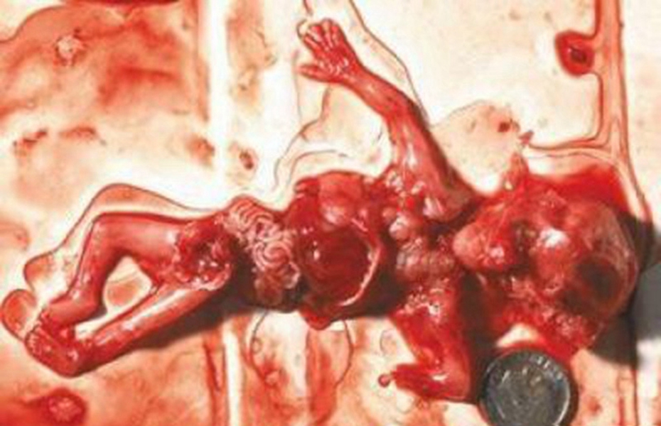 五个月胎儿人流下来图图片