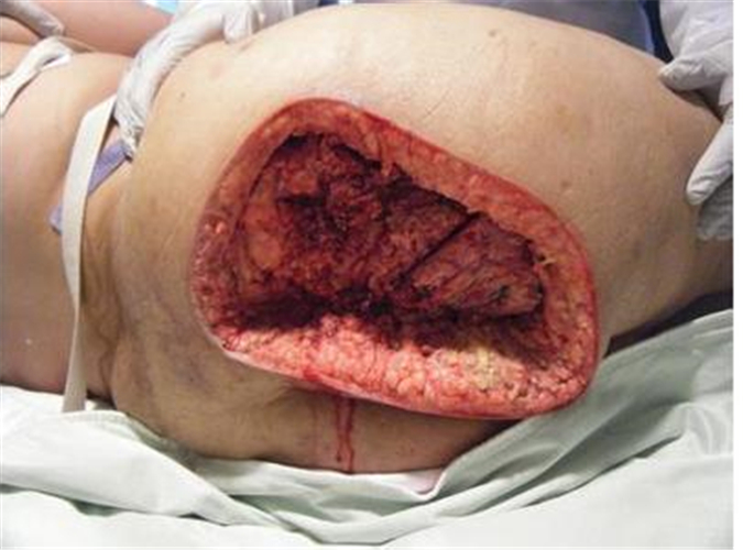 儿童腿部坏死性筋膜炎图片