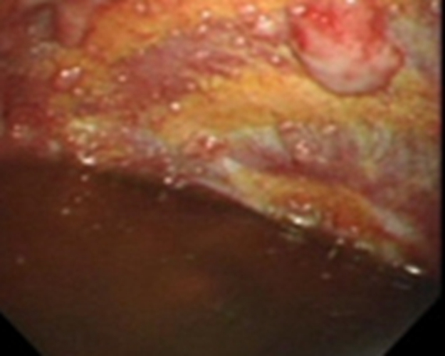 结核性胸膜炎的早期的症状的图片