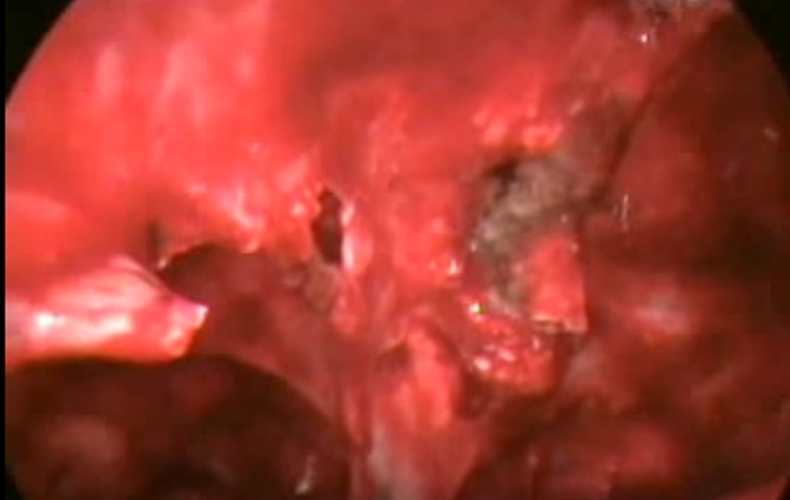 结核性胸膜炎红色积液的图片