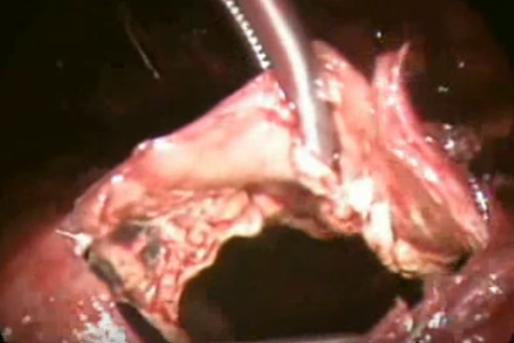 结核性胸膜炎手术的图片