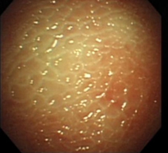 结核性胸膜炎早期症状图片