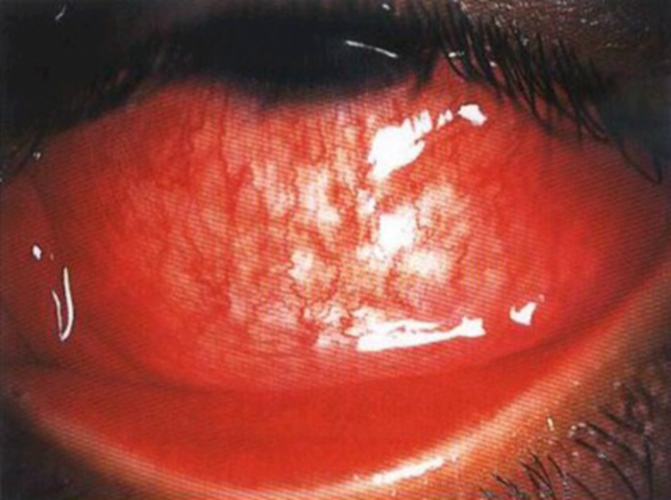 急性的传染性的结膜炎临床的表现的图片