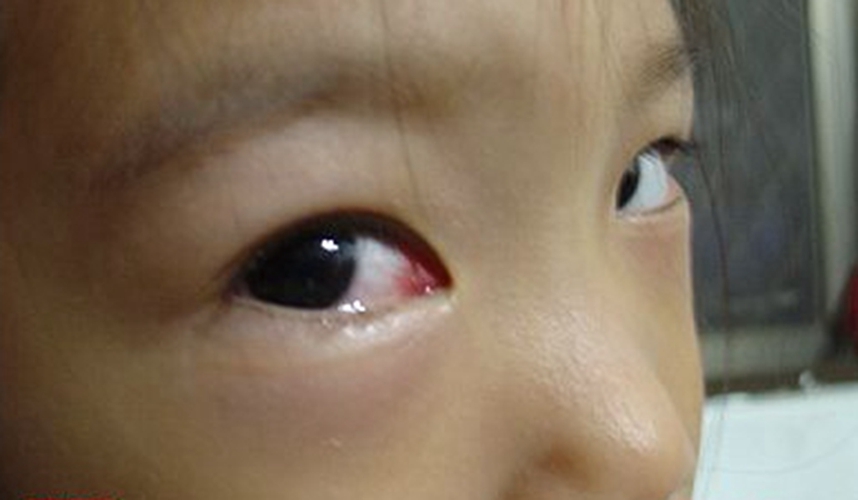 红眼病最初的症状图片图片