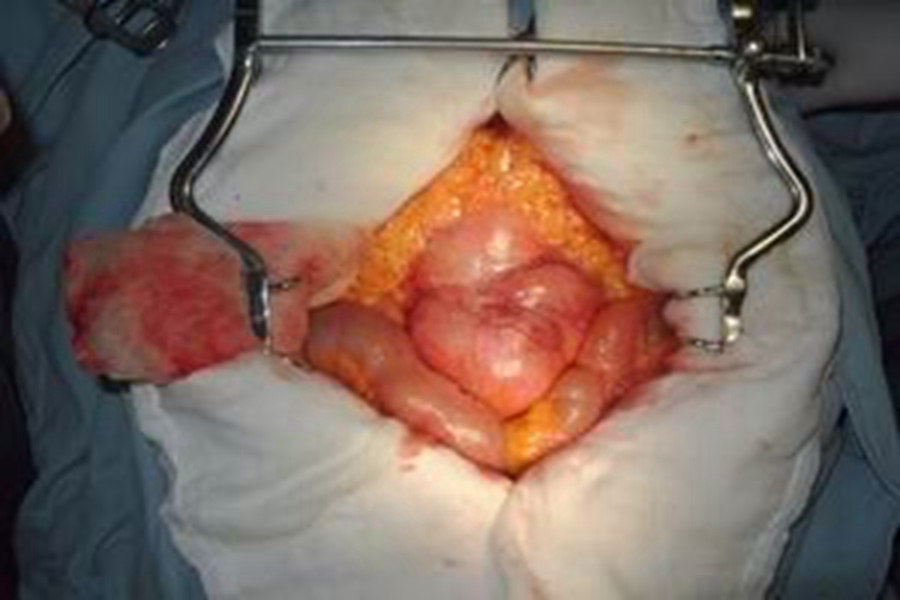 扁桃体淋巴瘤图片