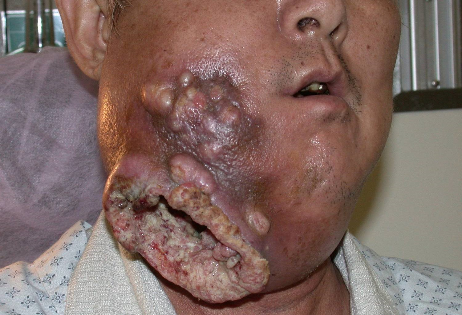 口腔癌脸部图片