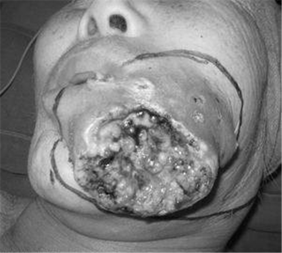 口腔癌脸部图片