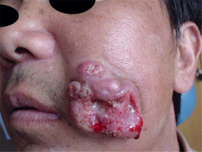 口颊癌的早期症状图片图片