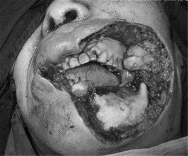 口腔癌脸烂图片 早期图片