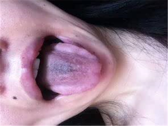 慢性肾炎及哮喘舌苔图片