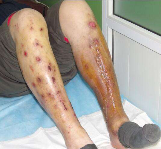 脉管炎是什么症状腿部图片