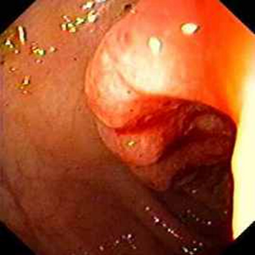  升结肠癌的肠镜图片