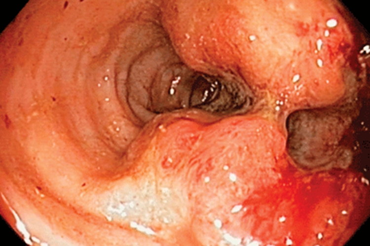  升结肠癌腺癌的肠镜图片