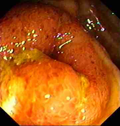  晚期结肠癌粘液腺癌症状的图片