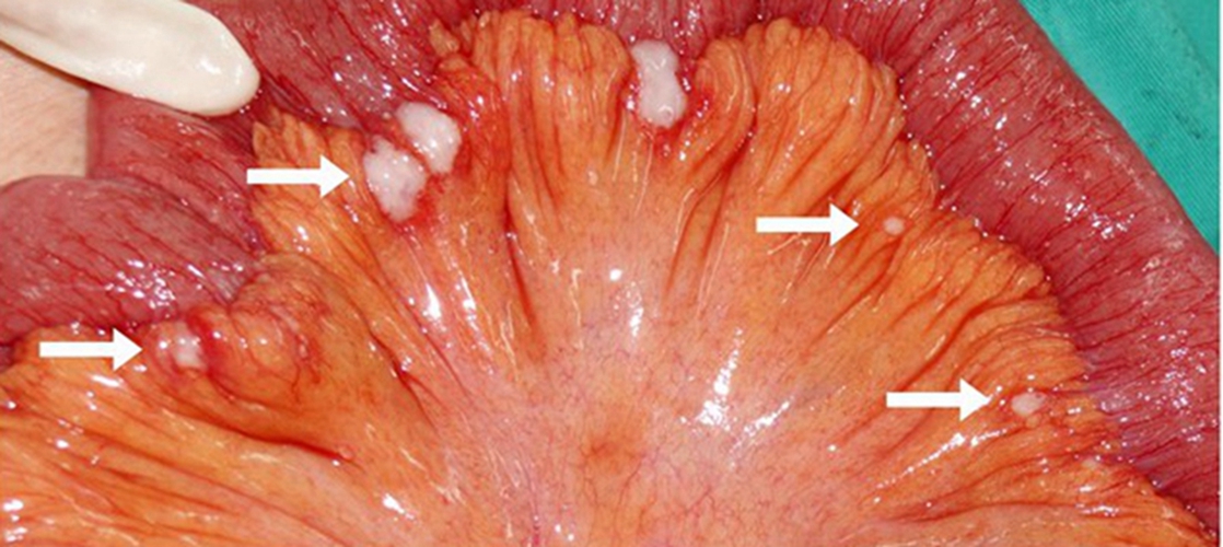  晚期的结肠癌腺癌三级症状 图片