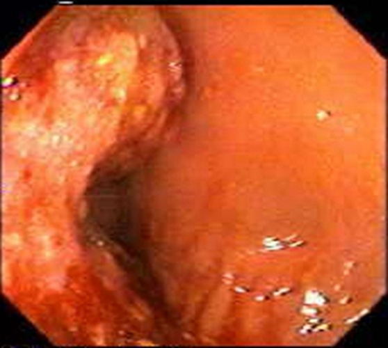  晚期结肠癌的粘液腺癌症状图片