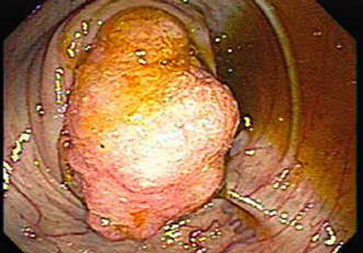  乙状 结肠癌早期症状图片