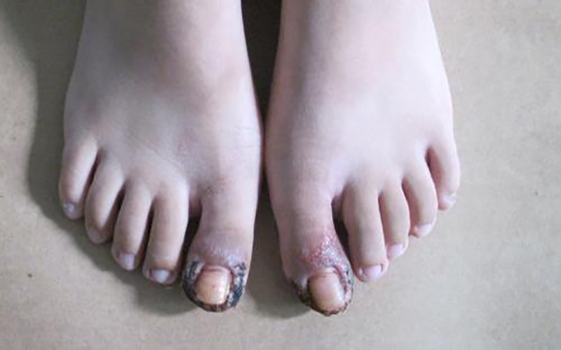 常见脚甲沟炎的症状图片