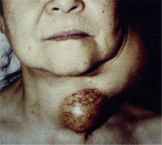 女人甲状腺癌图片