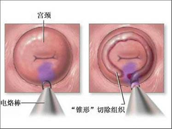 慢性宫颈炎治疗图片