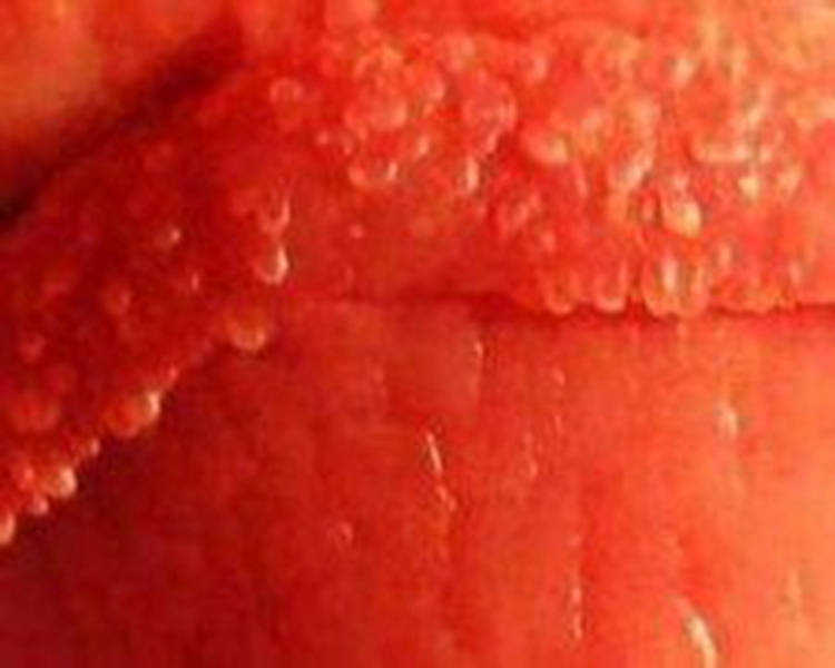淋球菌感染女性症状图片