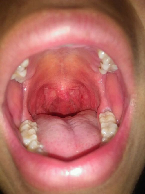 急性咽炎临床表现的图片