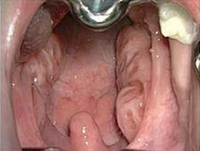 急性咽炎末期症状的图片