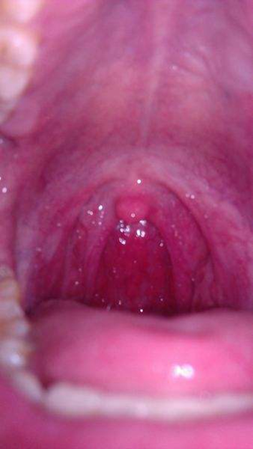 急性咽炎临床的表现图片