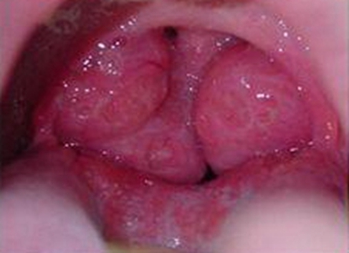 急性咽炎症状表现的图片