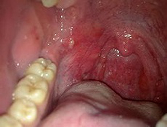 急性咽炎症状图片