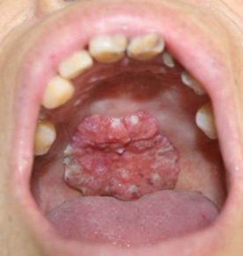 口腔癌照片早期图片