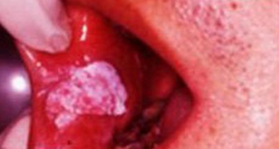 咬颊症口腔癌图片