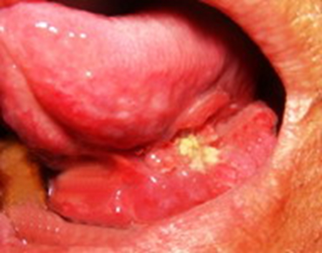 口腔癌早期的症状图片