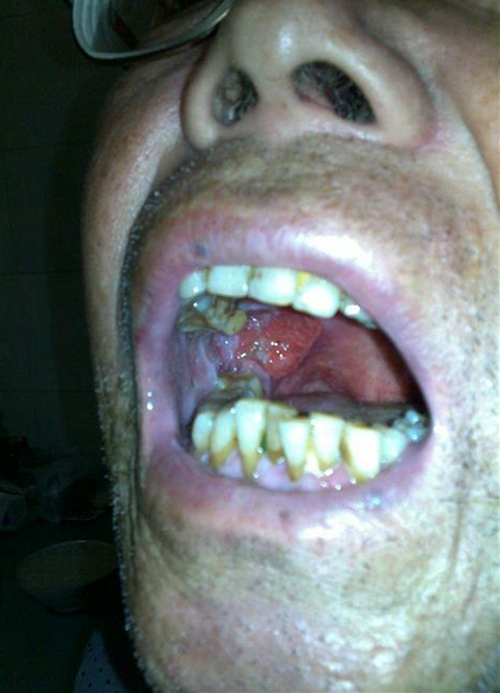 口腔癌症状图图片