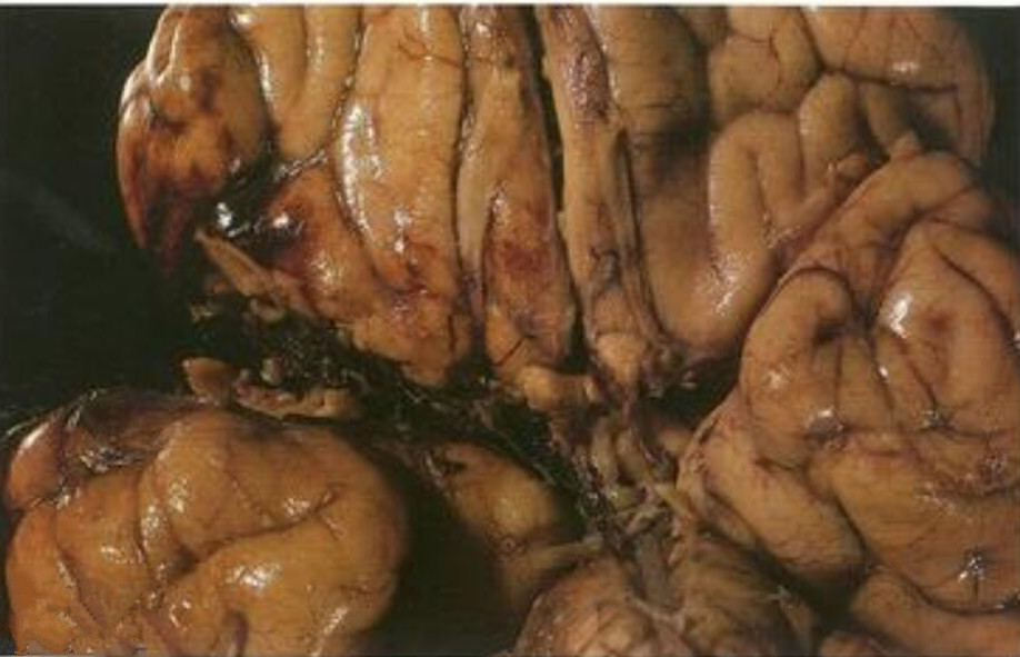 化脓性的脑膜炎生理解剖图片