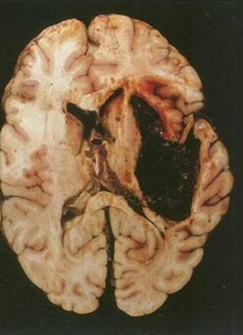 结核性脑膜炎解剖图片