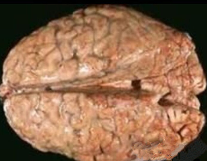 脑膜炎细菌性的脑部图片
