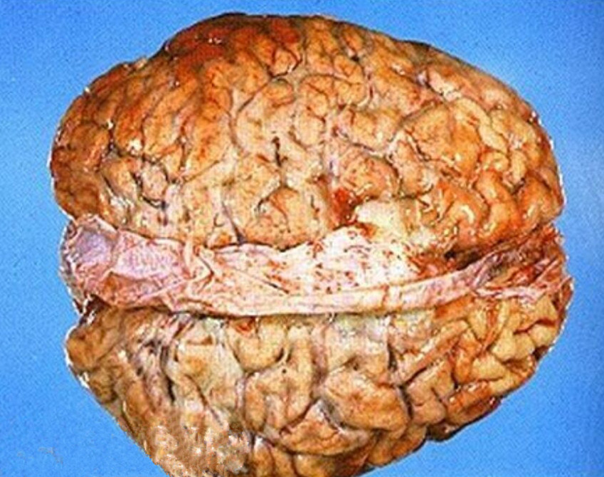 脑膜炎早期的图片